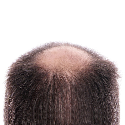 How to stop hair loss problems? (Alopecia Areata) | Causes | Medications | Products.